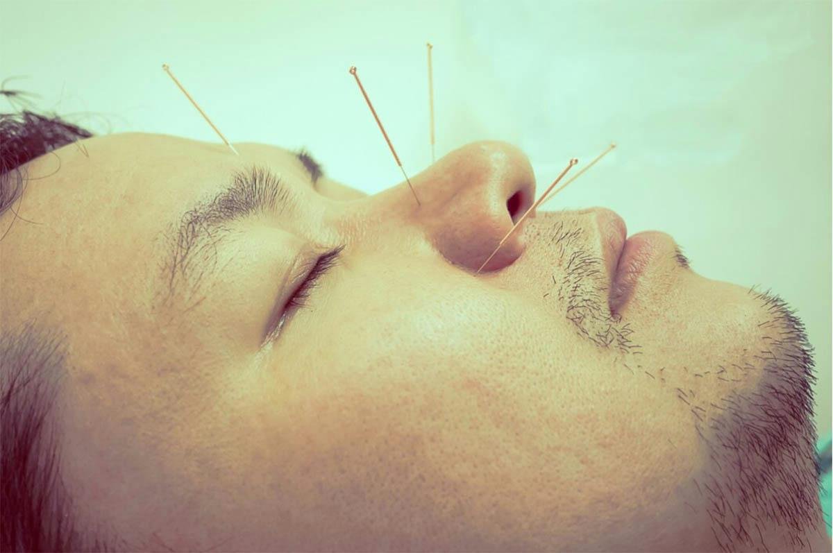 What Types of Migraines Can Be Treated with Dry Needling?