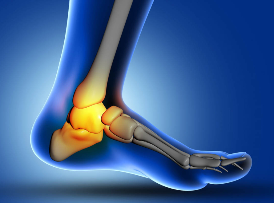 3 Things to OvercomePosterior Tibialialis Tendonitis