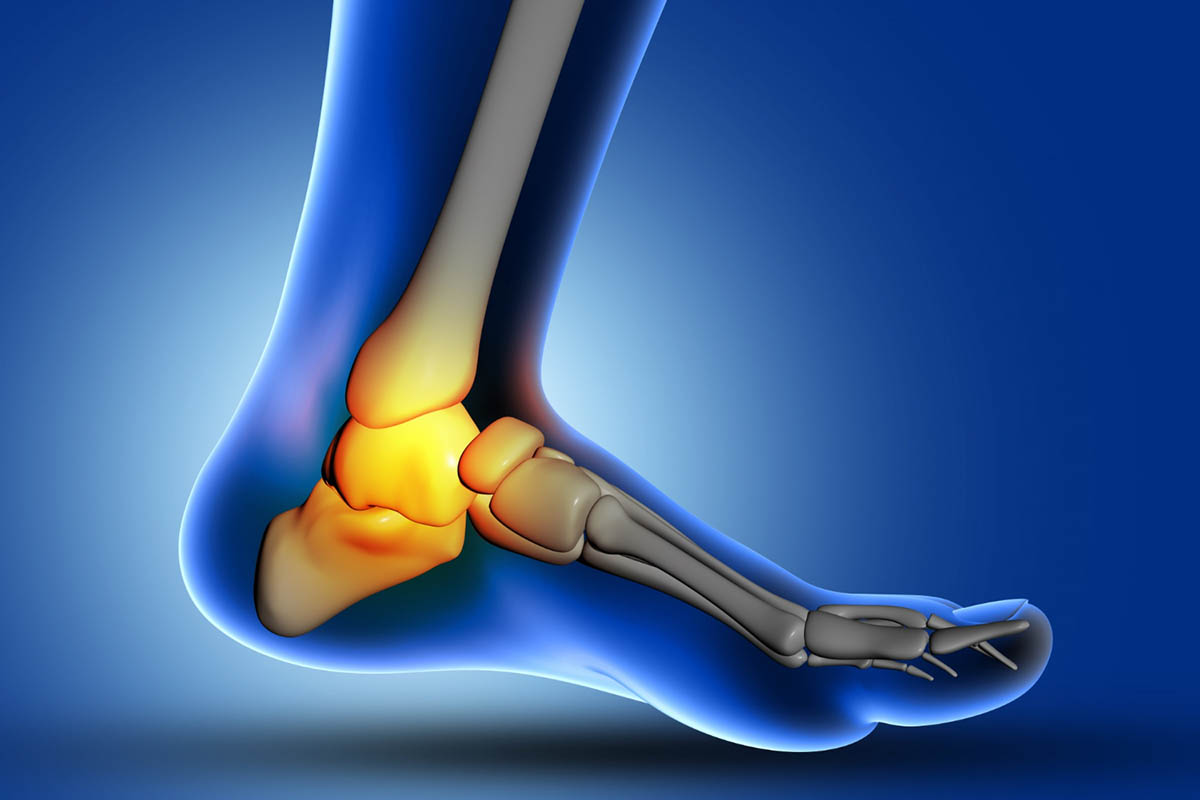 3 Things to OvercomePosterior Tibialialis Tendonitis