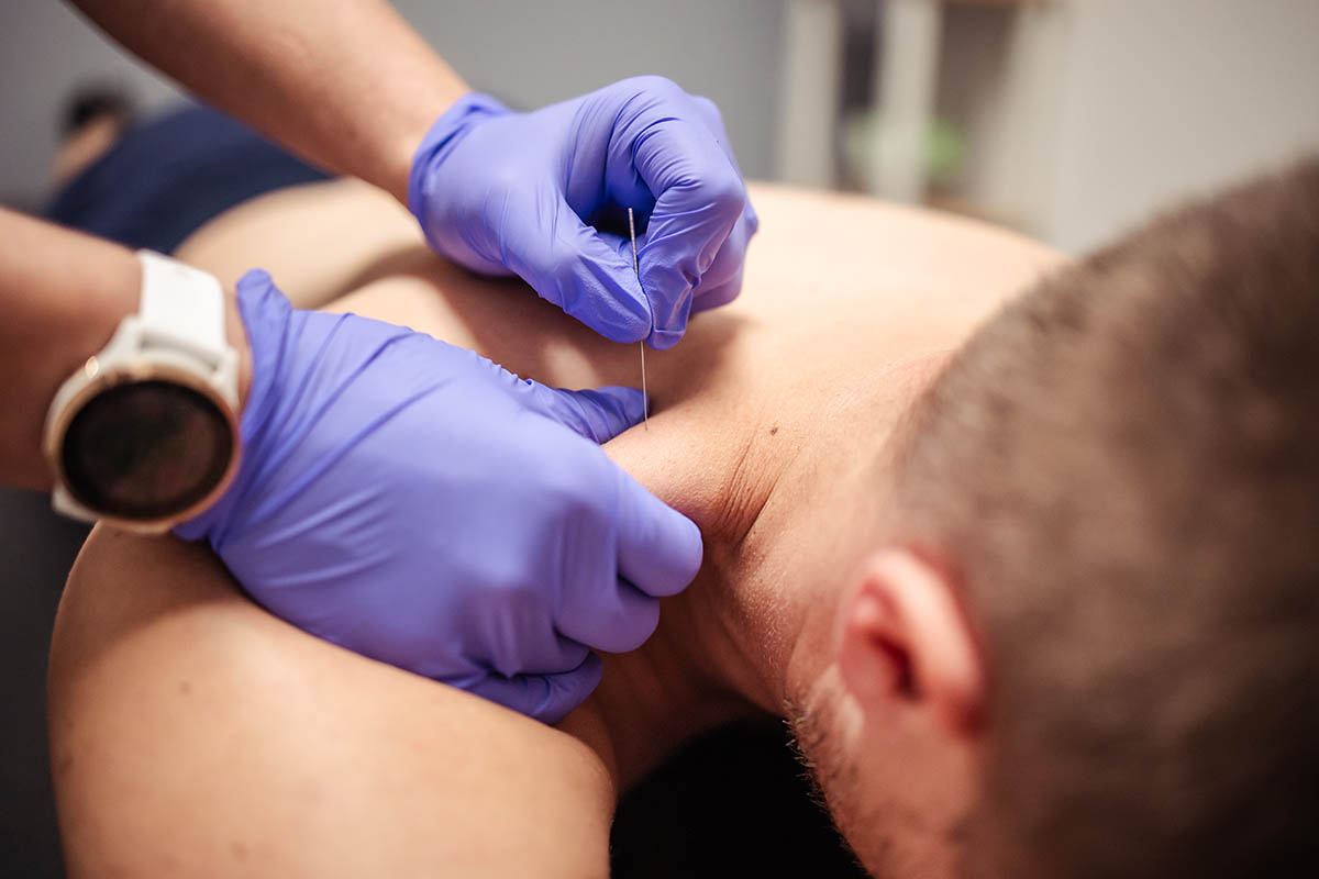 Differences Between Dry Needling and Acupuncture