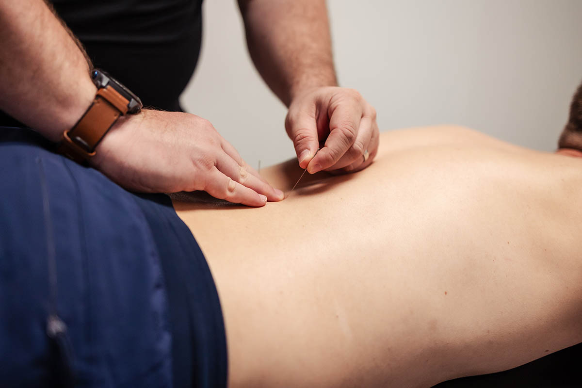 Choosing Between Dry Needling and Acupuncture